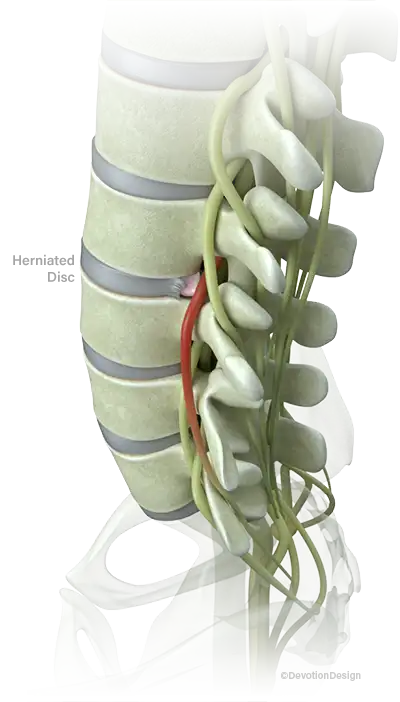 Herniated disc illustration
