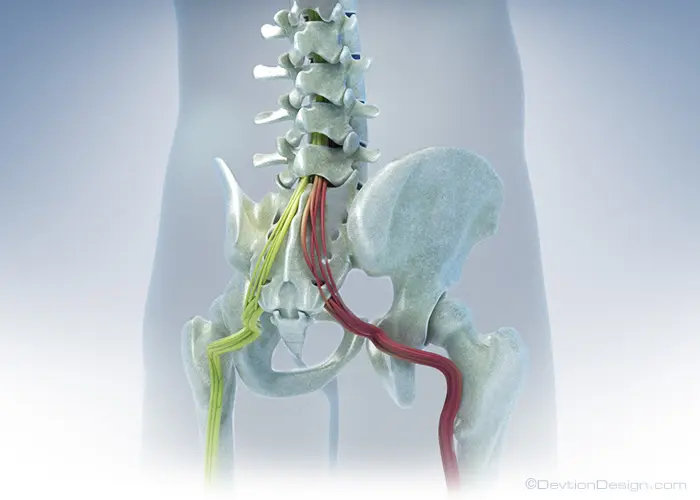 Illustration of sciatica and spinal nerve irritation