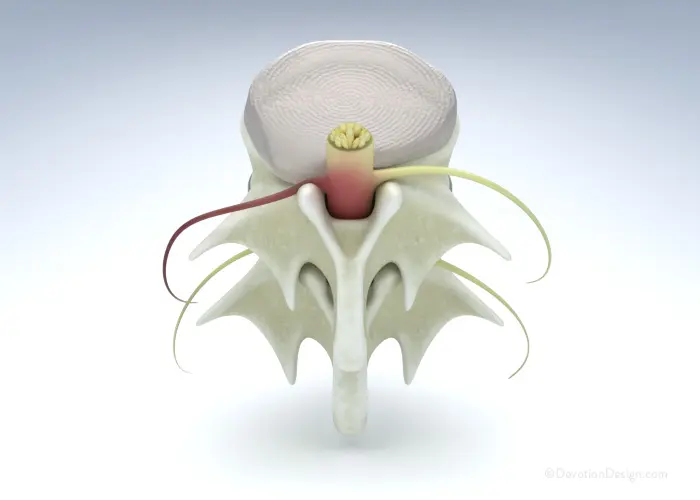 Bulging intervertebral disc illustration