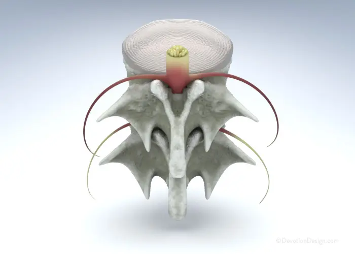 Spinal Stenosis